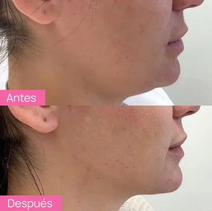 Dispositivo de Lifting Facial Skindion | Gel Conductor de Regalo
